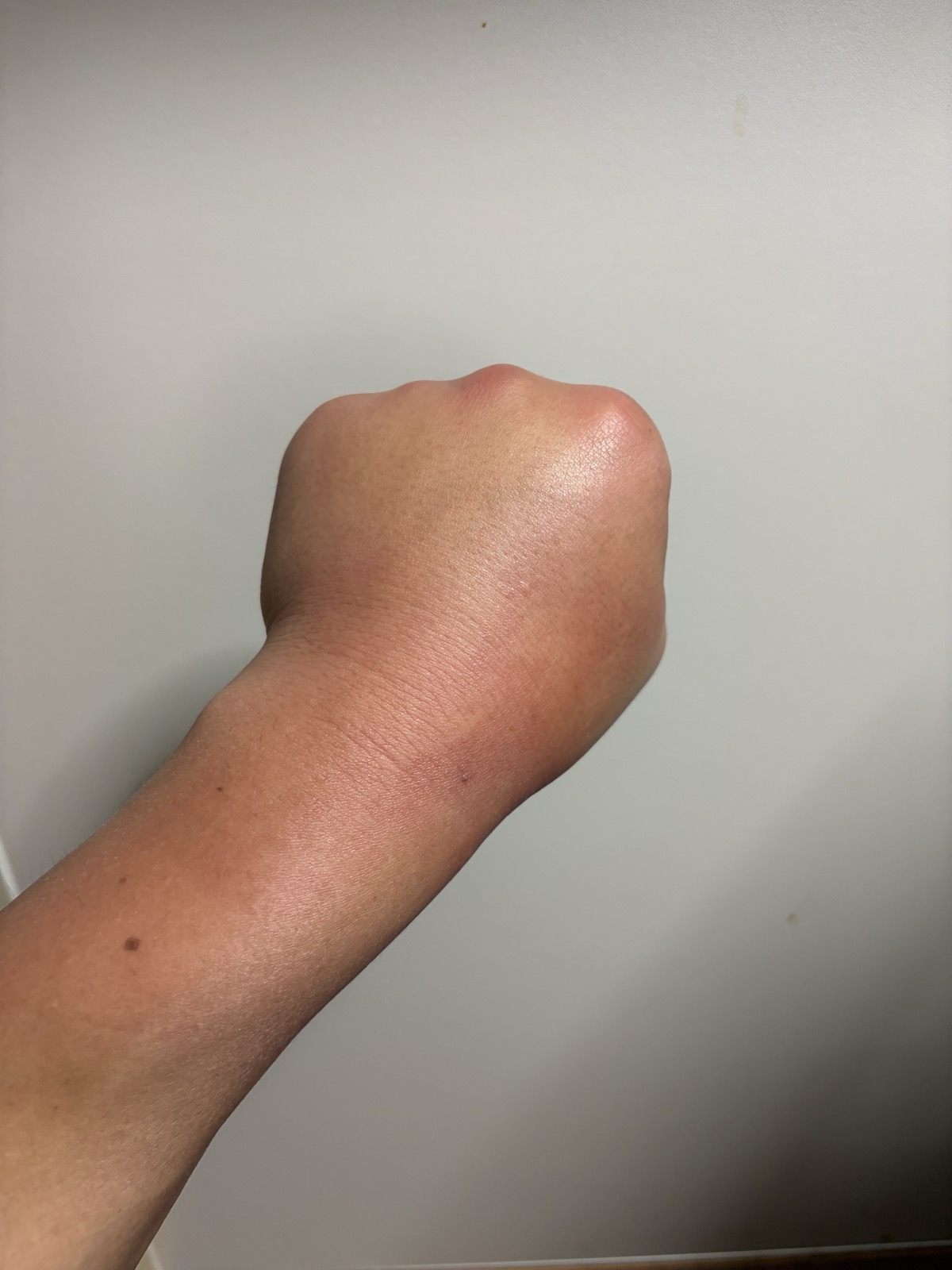 刺されて24時間後、パンパンに腫れた拳