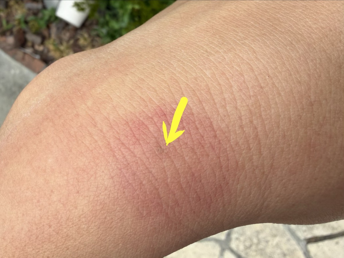 刺された直後の手首。矢印の先に刺し口